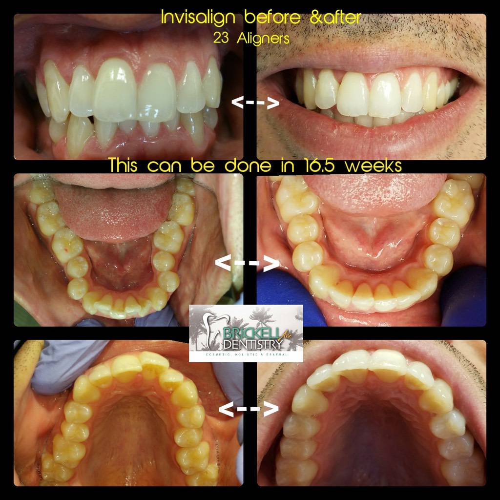 Invisalign 23 aligners before and after