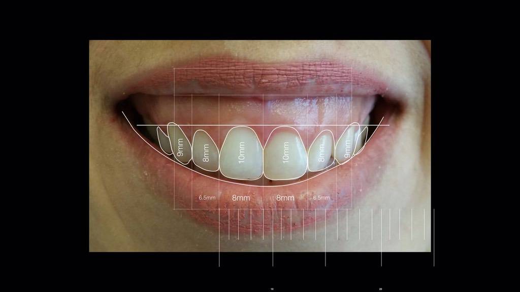 teeth with measurements