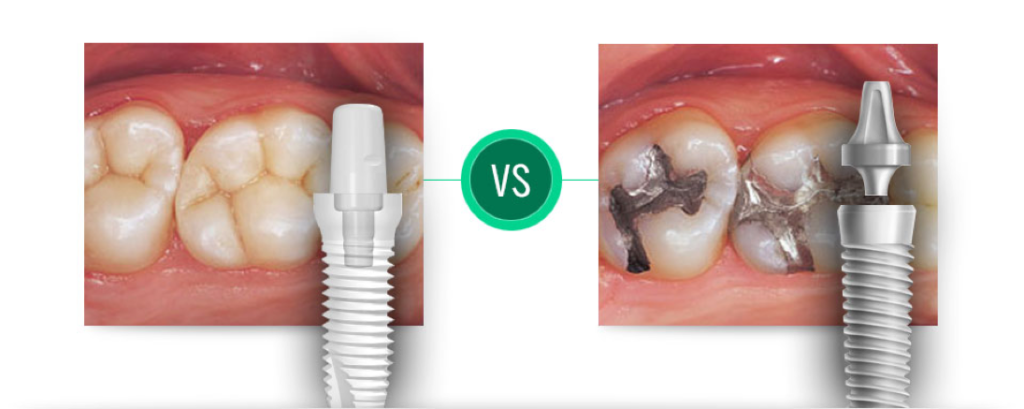 ceramic dental implants vs traditional metal implants