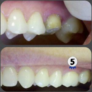 improved teeth with Bruxzir crowns