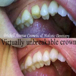 Virtually Unbreakable Crown