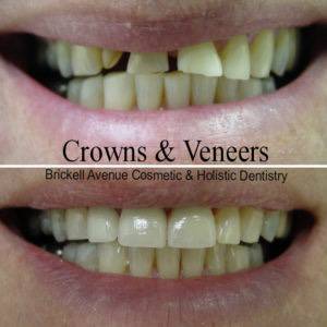 improved teeth with crowns and veneers