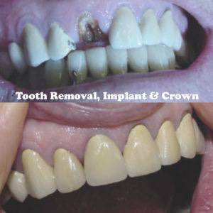 Tooth Removal, Implant, and Crown