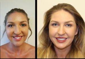 a before and after collage of a woman after dental treatment