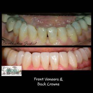front veneers and back crowns