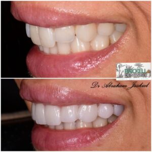 photos of a patient before and after a tooth whitening treatment