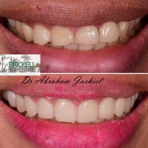 before and after photos of a patient with dental veneers
