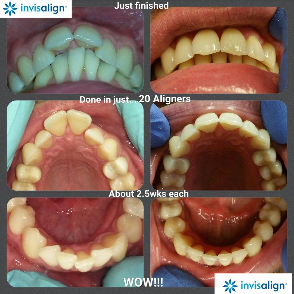 a collage of Invisalign photos done in different timeframes