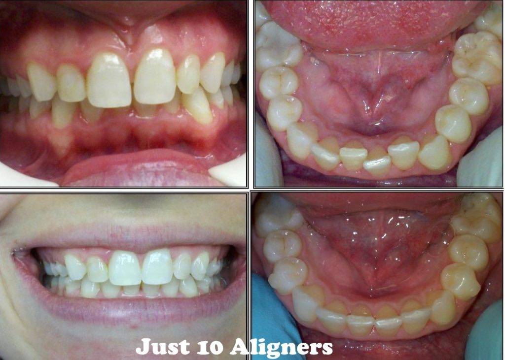 before and after teeth alignment
