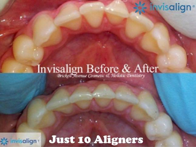Invisalign service before and after