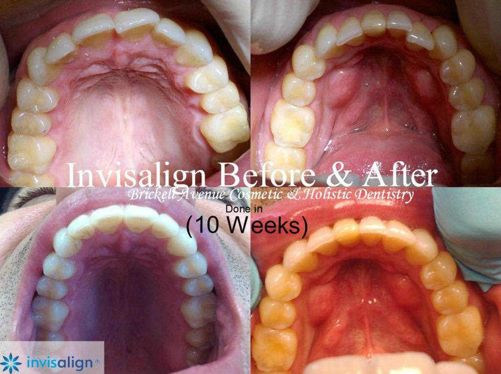 Invisalign before and after done in 10 weeks