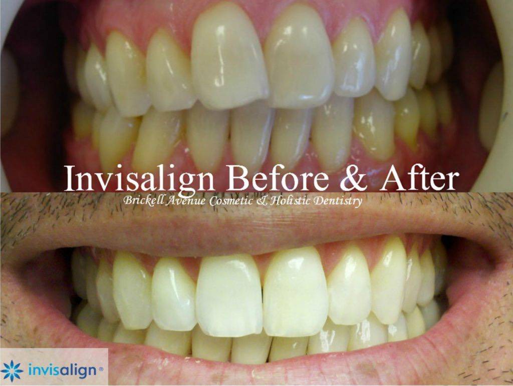before and after an Invisalign treatment