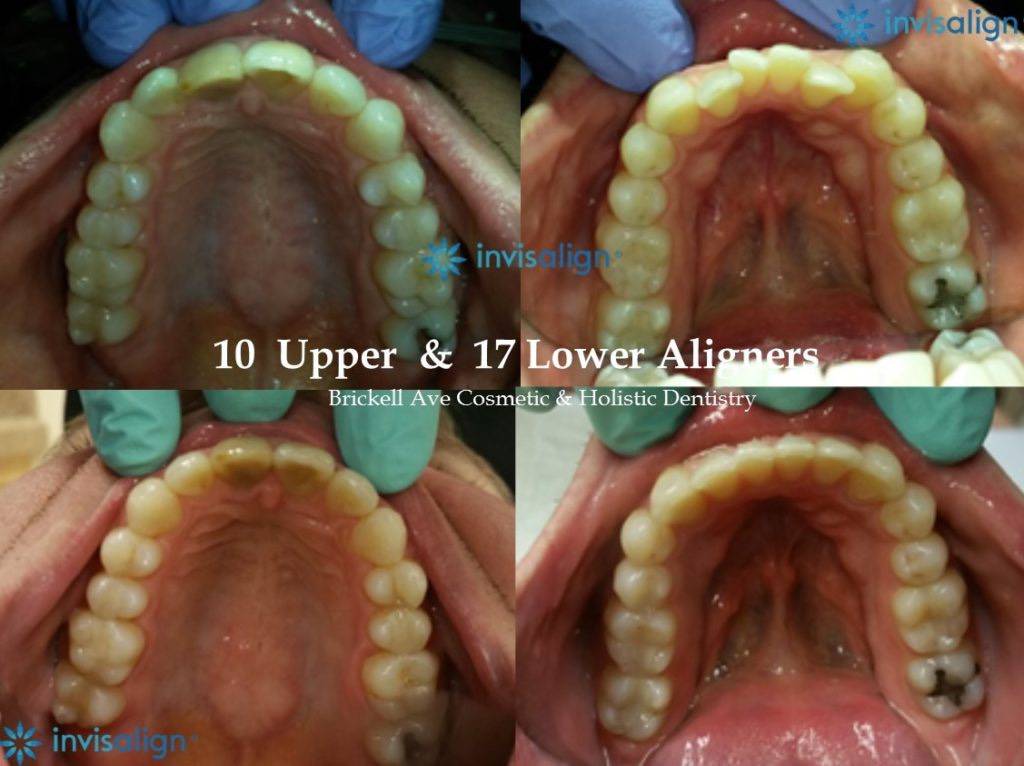 upper and lower teeth alignment